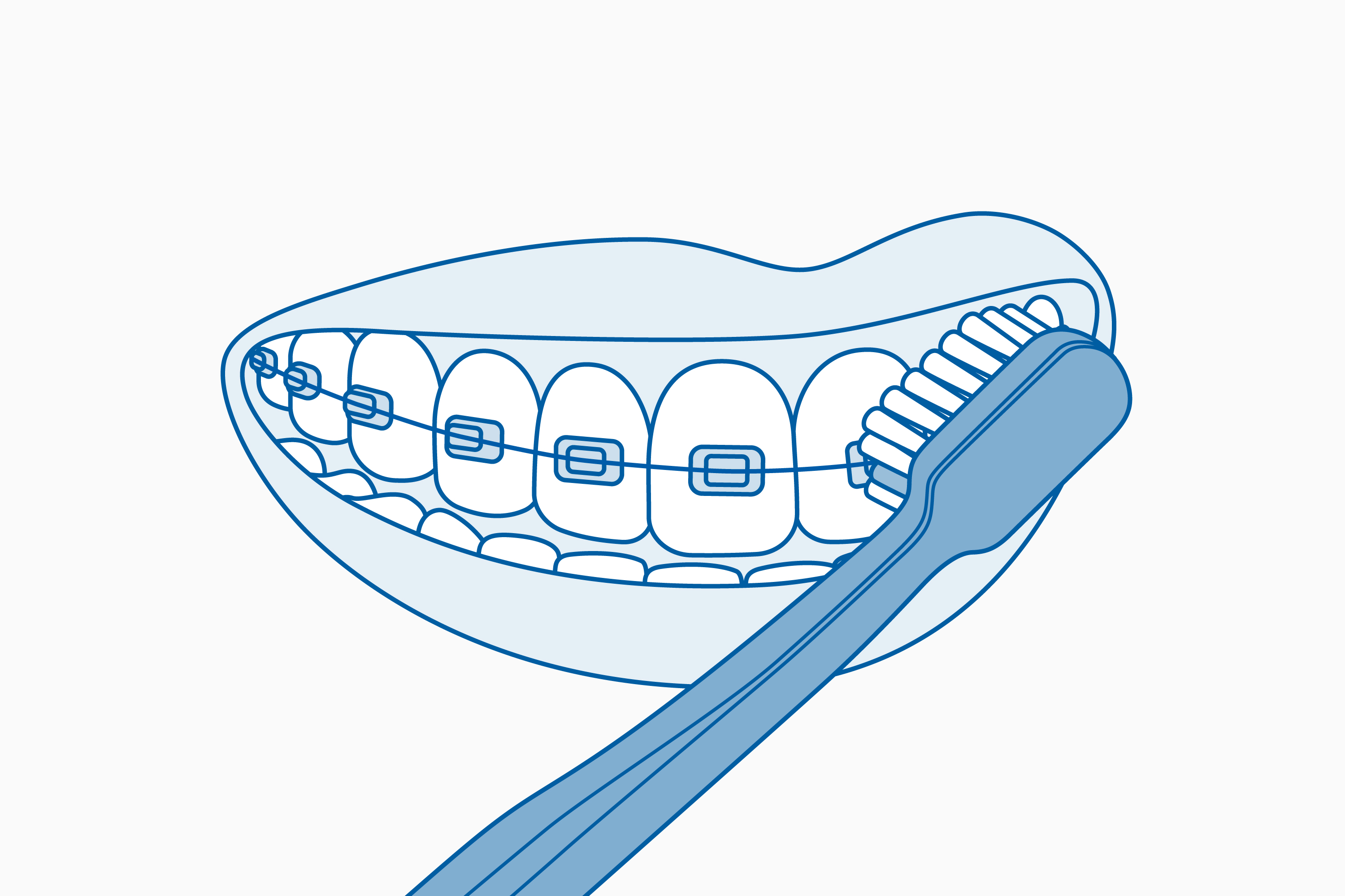 Curaprox CS 5460 ortho fogkefe használata